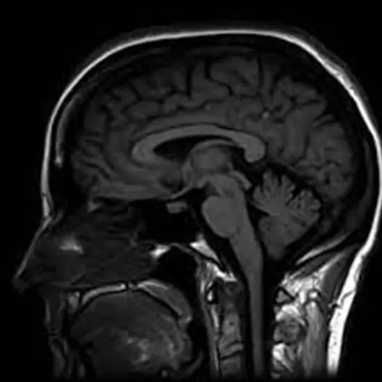 MRI Brain With Contrast